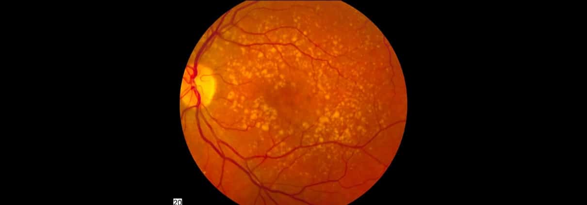 Macular Degeneration